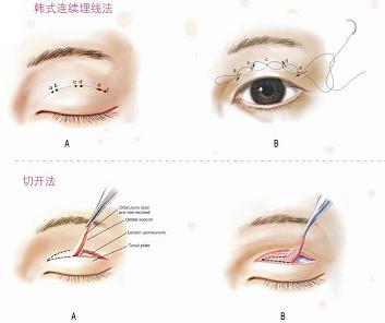 韩式三点双眼皮手术 安全自然恢复_武警北京市